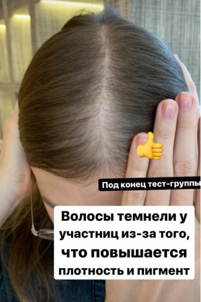 Волосы - выпадения и алопеции. Елена Корнилова