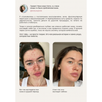 Проблемная кожа. katyaspivak