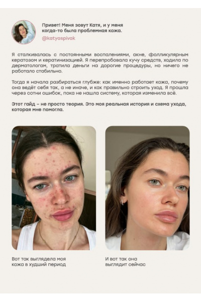 Проблемная кожа. katyaspivak