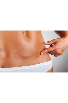 Работа с рубцами с помощью кинезио и кросс тейпирования. Валентин Гайт, BBalance